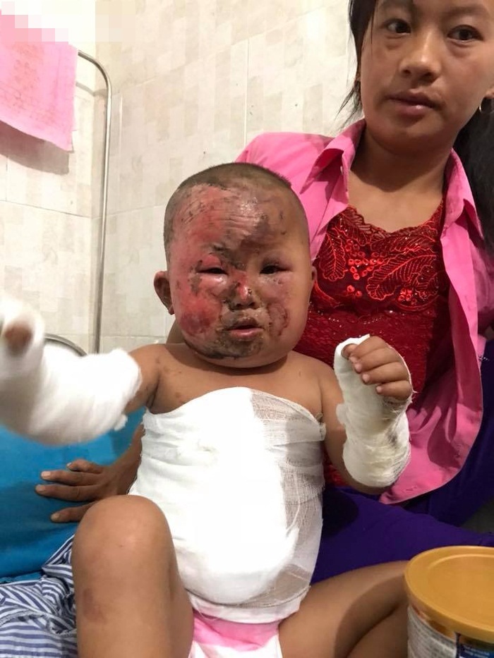 bé bị bỏng, xót xa bé 3 tuổi bị bỏng nặng vì bất cẩn của mẹ