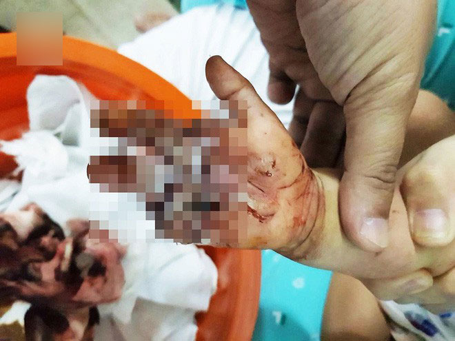 bé 2 tuổi bị đứt lìa ngón tay vì kẹp xích xe