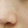 Cách trị mụn cám đơn giản giúp da láng đẹp không tì vết